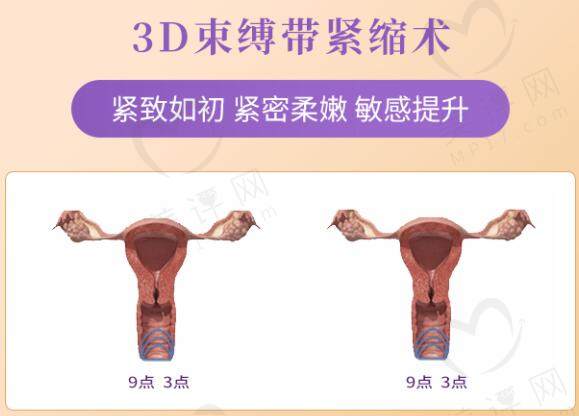 八爪鱼缩阴术和3D生物束带术有哪些区别？