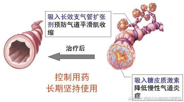 哮证发作期有哪几种？不同种类的哮证发作期又该如何治疗？