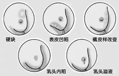 乳头变白色原因解析：正常乳头颜色及异常情况详解