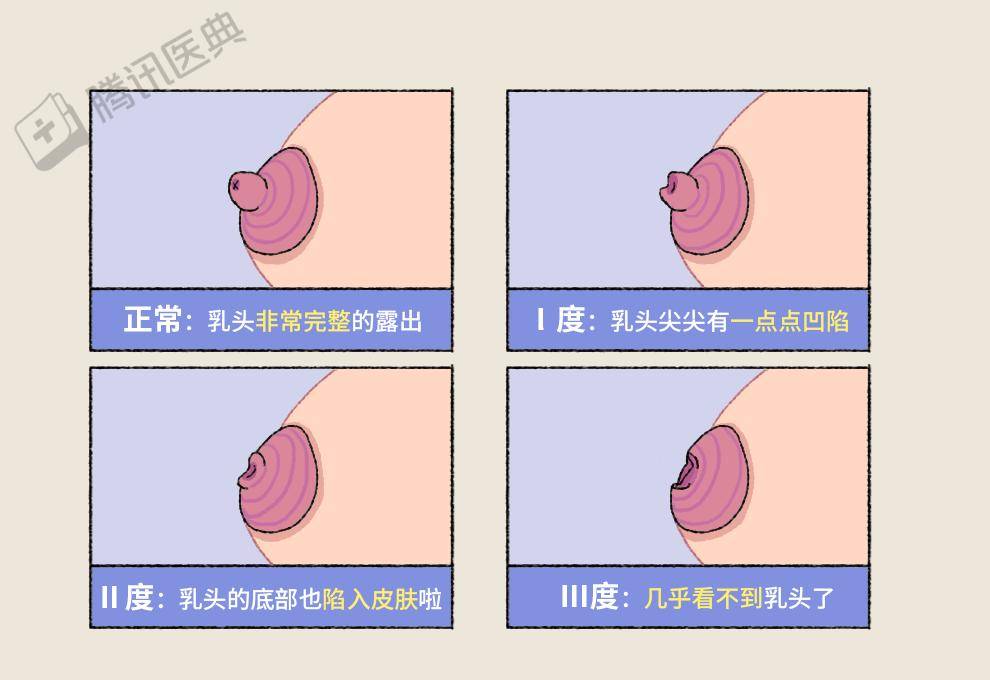 乳头变白色原因解析：正常乳头颜色及异常情况详解