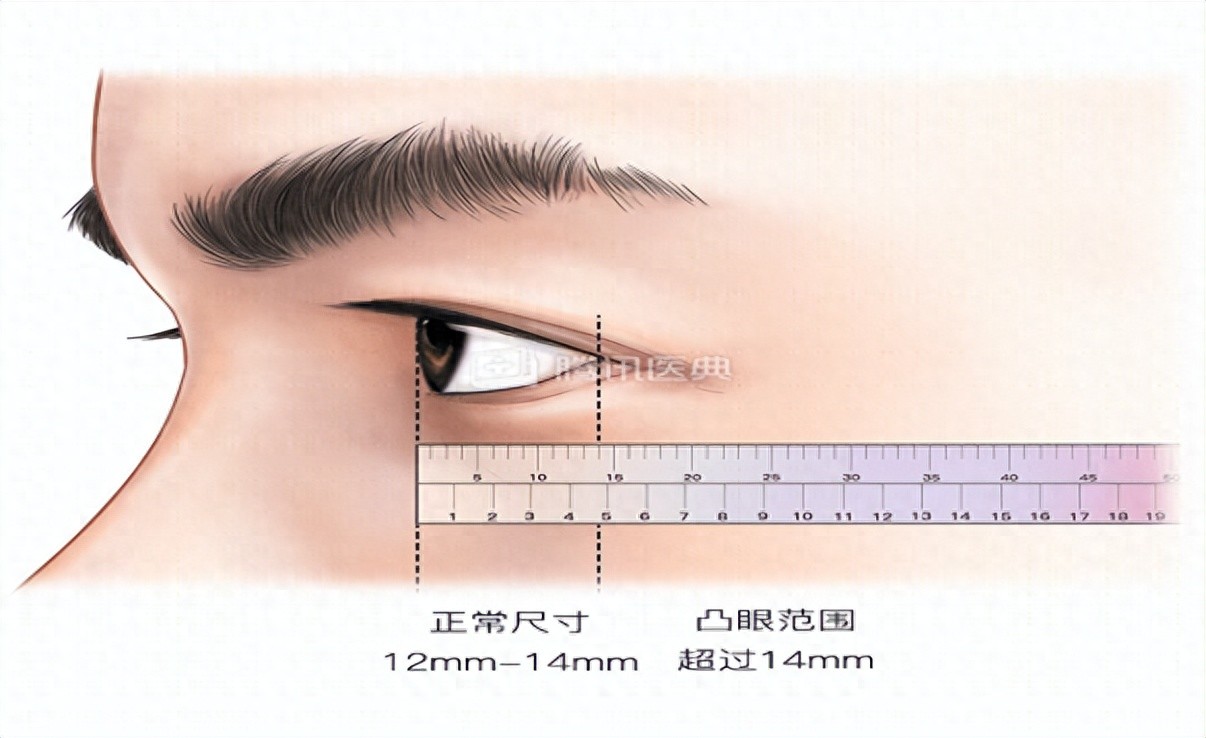 眼球突出是不是病？原因、症状与治疗方法全解析