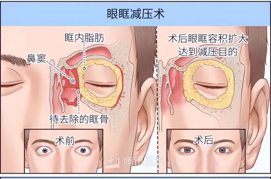 眼睛突出能不能恢复_眼睛突出怎么改善_眼睛突出怎么矫正