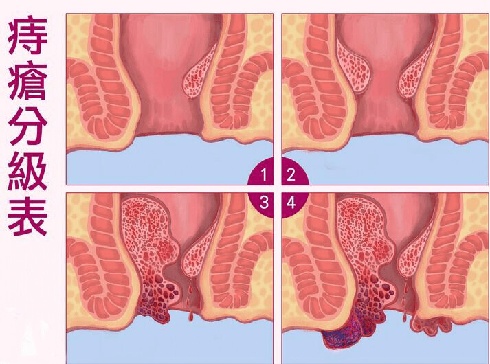哪种痔疮膏效果好_痔疮膏药方_痔疮的膏药买什么样的管用